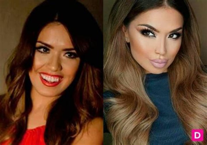 "iluvsarahii Before And After BBL"