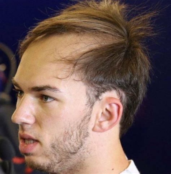 Is Pierre Gasly Bald Now? What Happened To His Hair? Health